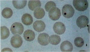 Corpos de Jolly em eritrócitos (coloração de Wright’s)